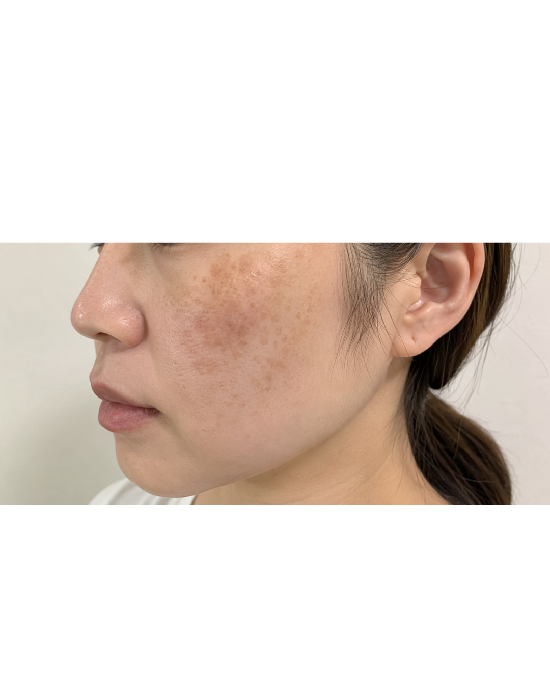 すみ・肝斑治療はエクラ美容クリニックにお任せください